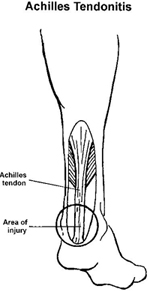 Achilles Tendon