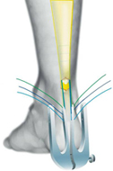 Achilles Tendon