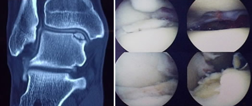 Osteochondral Defects