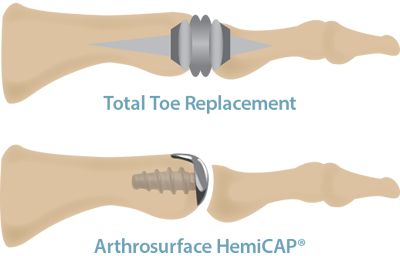 Toe replacement systems