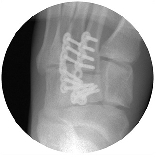 Intra Operative Surgical Reconstruction Xray