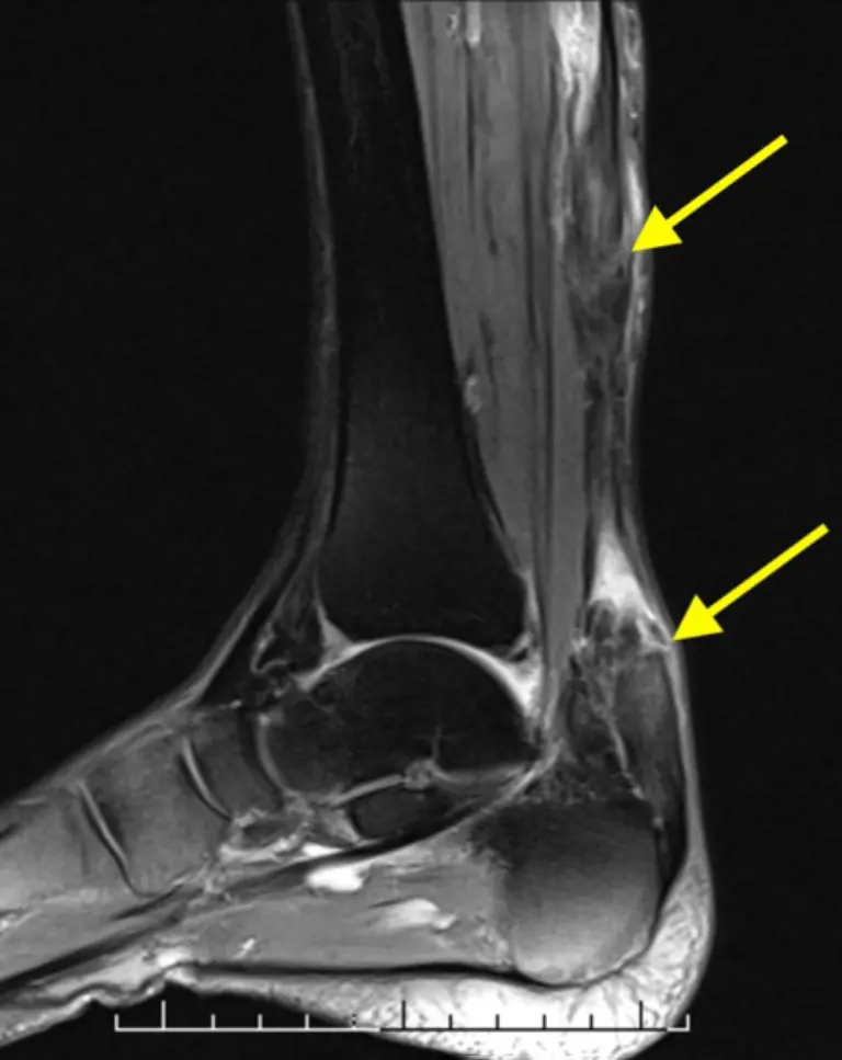 Ankle Replacement Xray