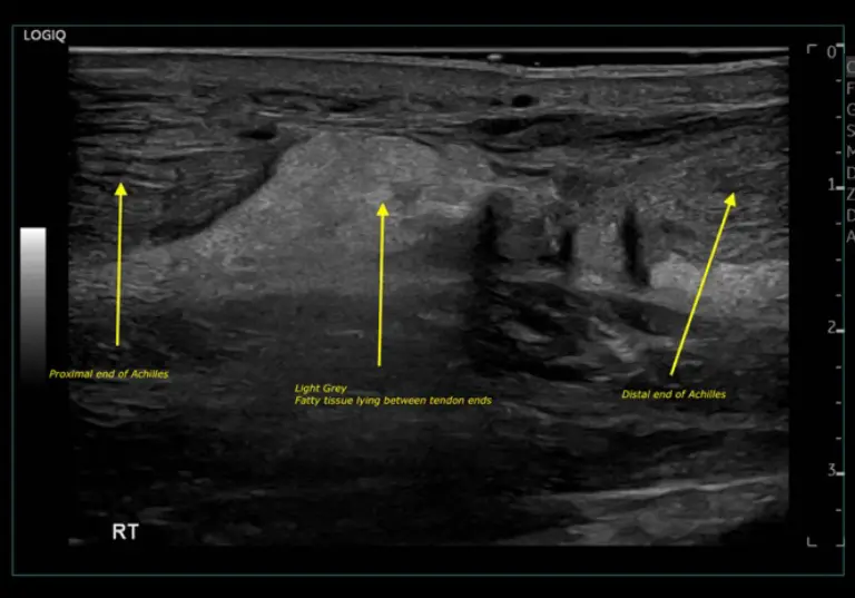 Achilles Tendon Ultrasound Scan