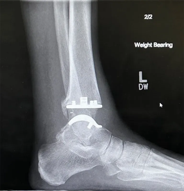 Ankle Arthroplasty