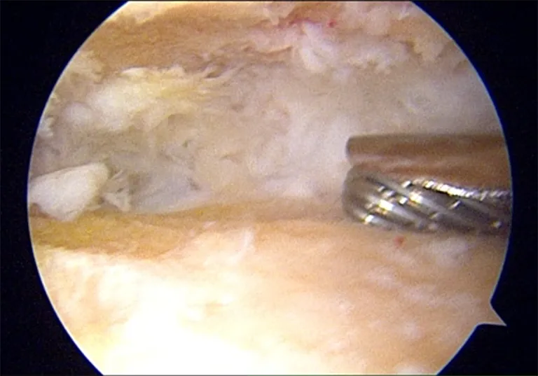 Arthroscopic Arthrodesis