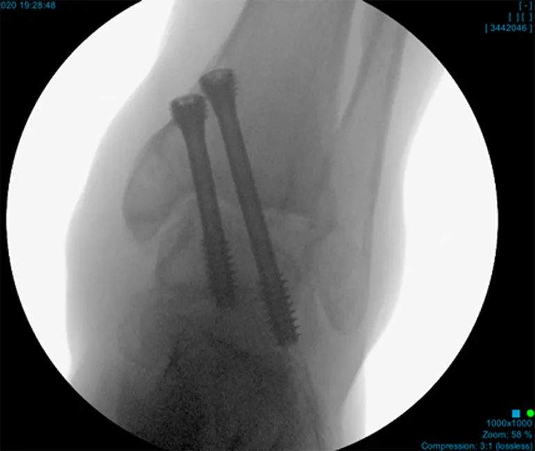 Arthroscopic Arthrodesis Xray