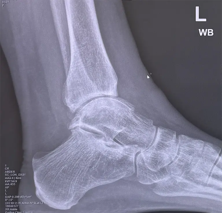 Arthroscopic debridement after