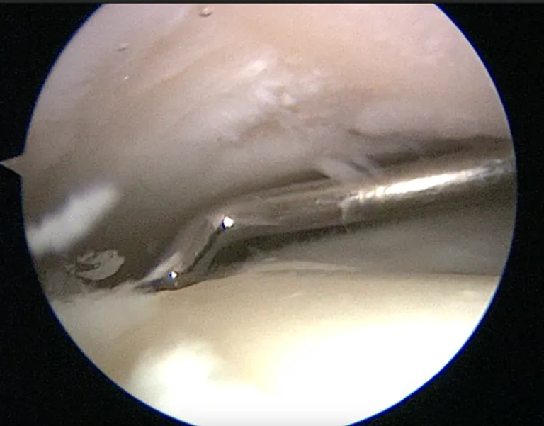 Arthroscopic Debridement