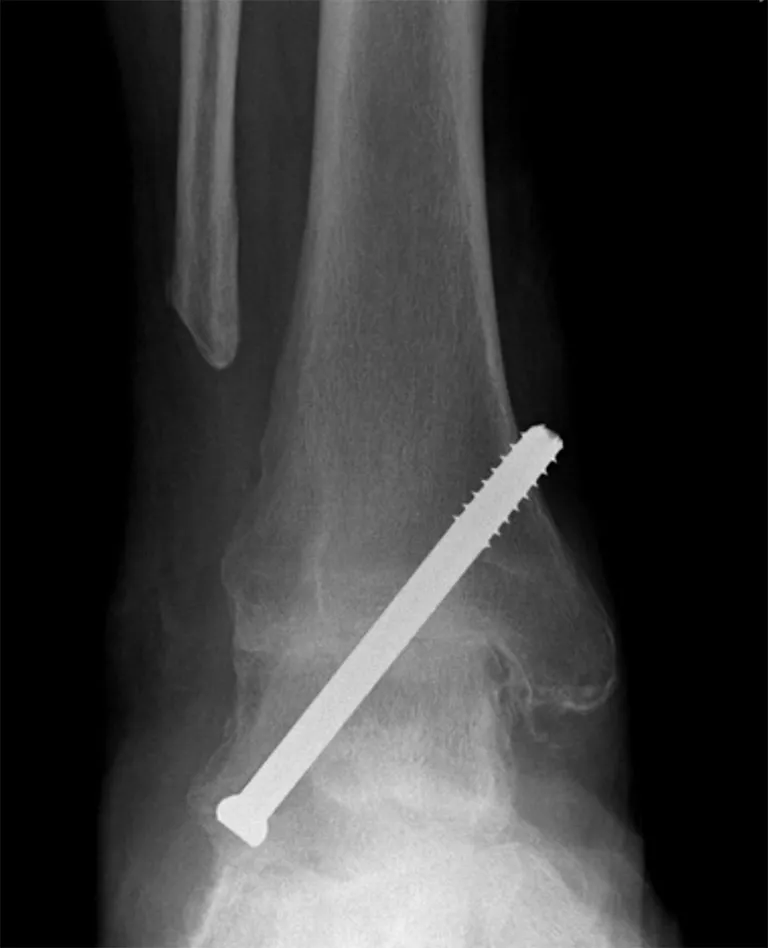 Open Arthrodesis