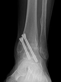 Ankle Fusion Arthroscopic