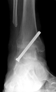 Ankle Fusion