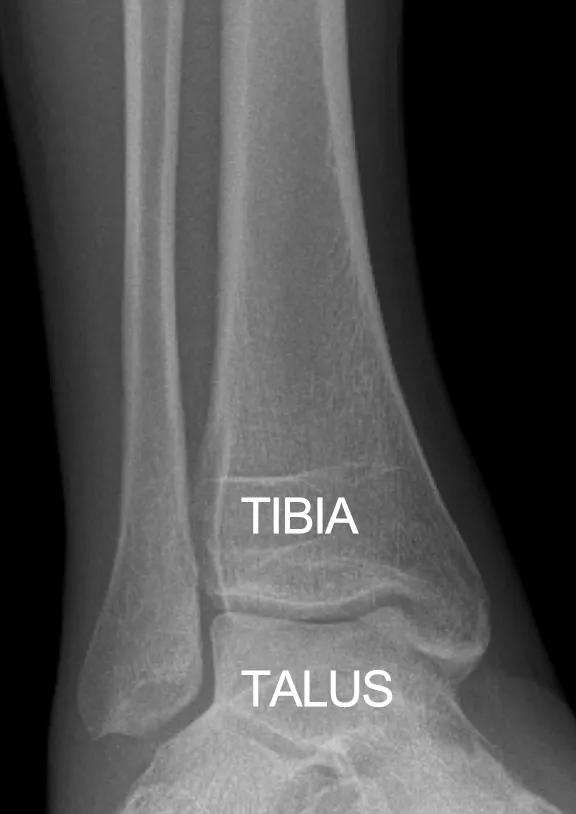 Ankle joint