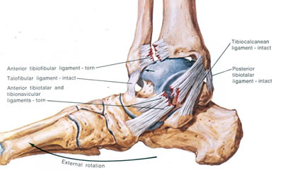 Ankle Ligament Tear