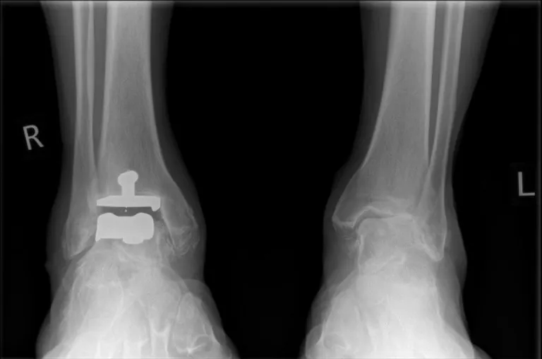 Ankle Replacement Xray