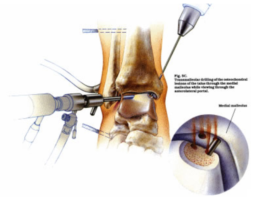 Anterior Arthroscopy