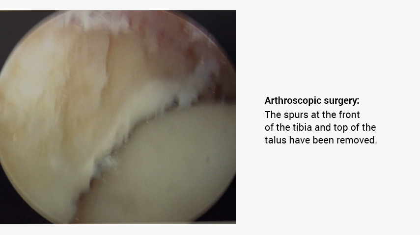 Arthroscopic surgery