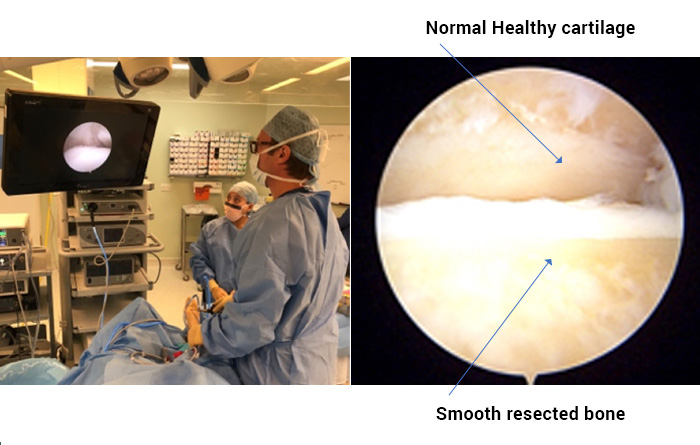 Arthroscopy of the joint