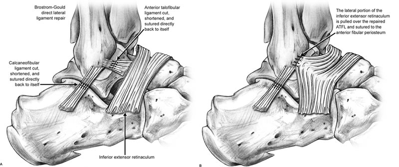 Brostrom Repair diagram