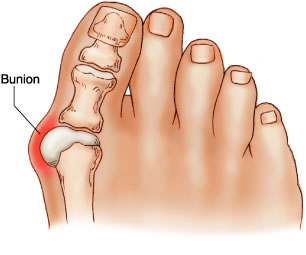 Bunion diagram