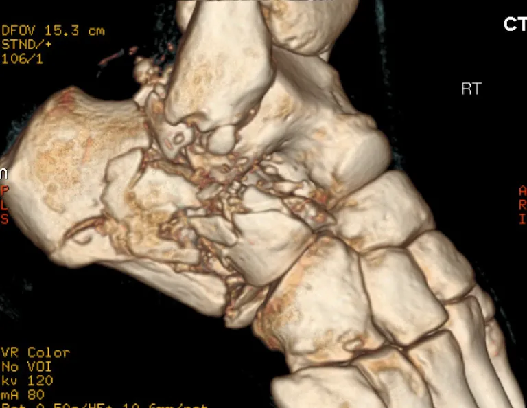 Calcaneal Fractures Xray
