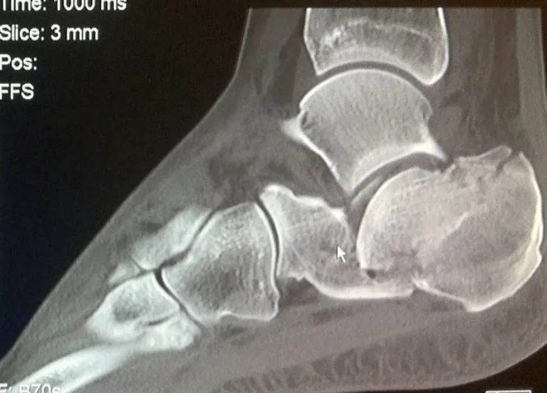 Calcaneal Fractures Xray