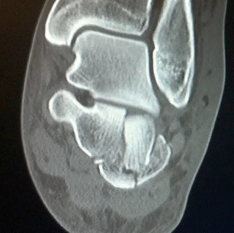 Calcaneal Fractures Xray