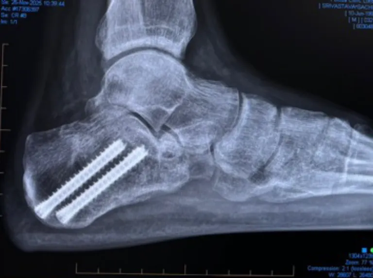 Calcaneal Fractures Xray