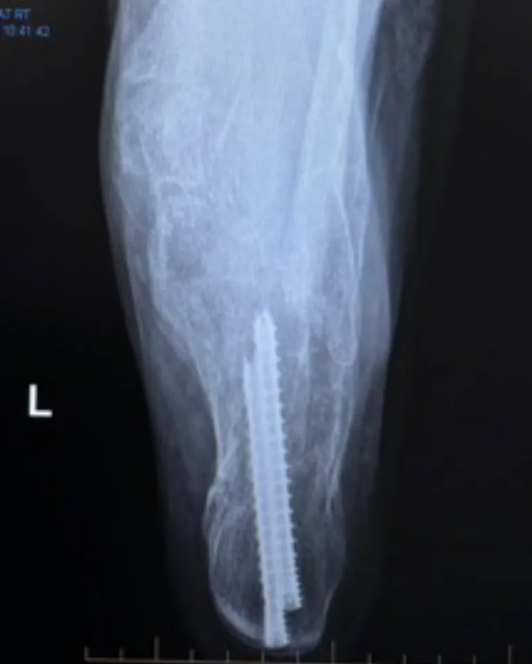 Calcaneal Fractures Xray