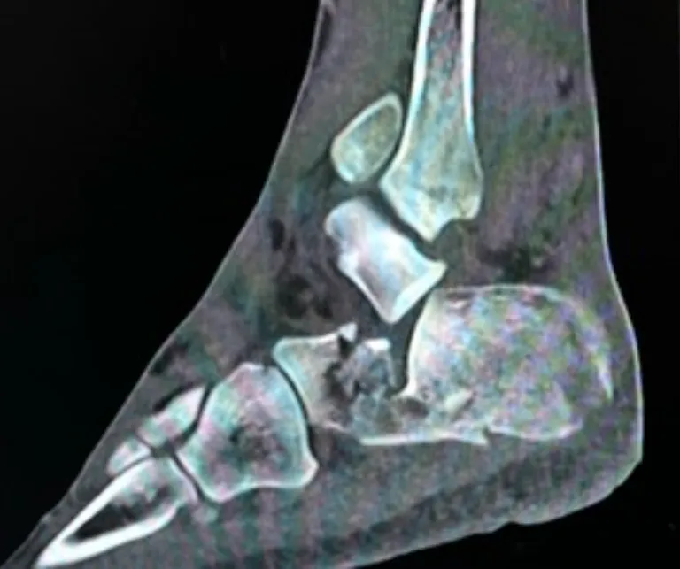 Calcaneal Fractures Xray