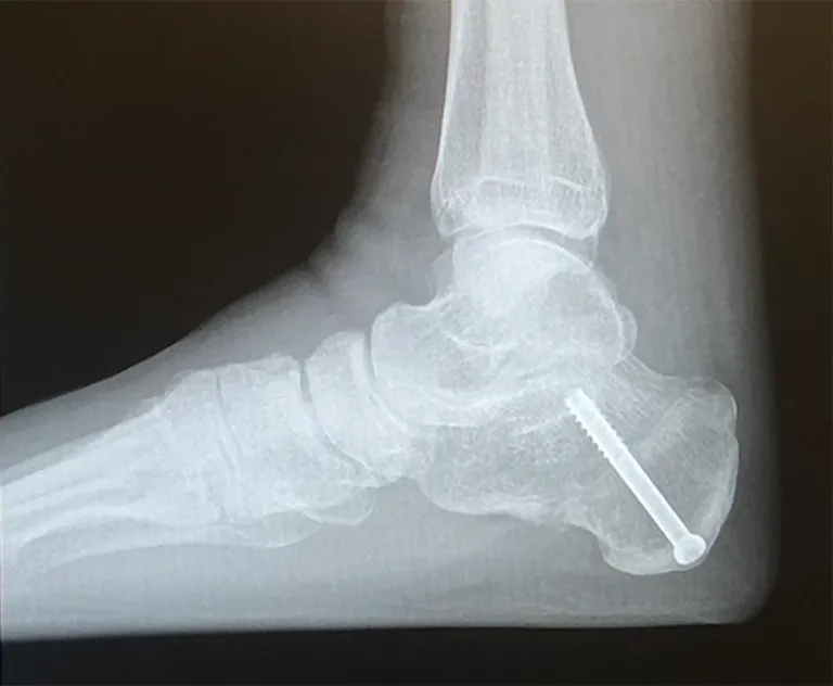 Calcaneal osteotomy