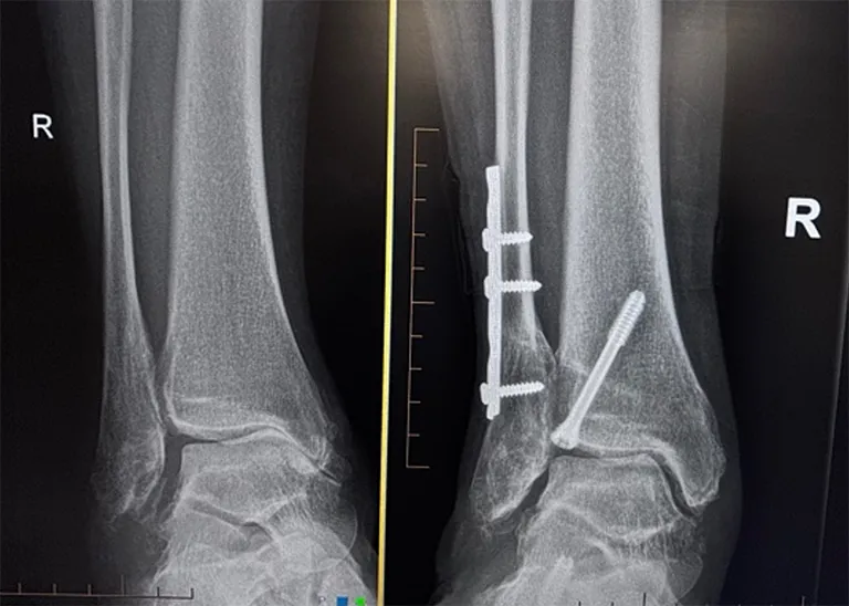 Distal tibia & calcaneal osteotomies