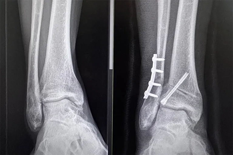 Distal Tibial Realignment Osteotomy Surgery