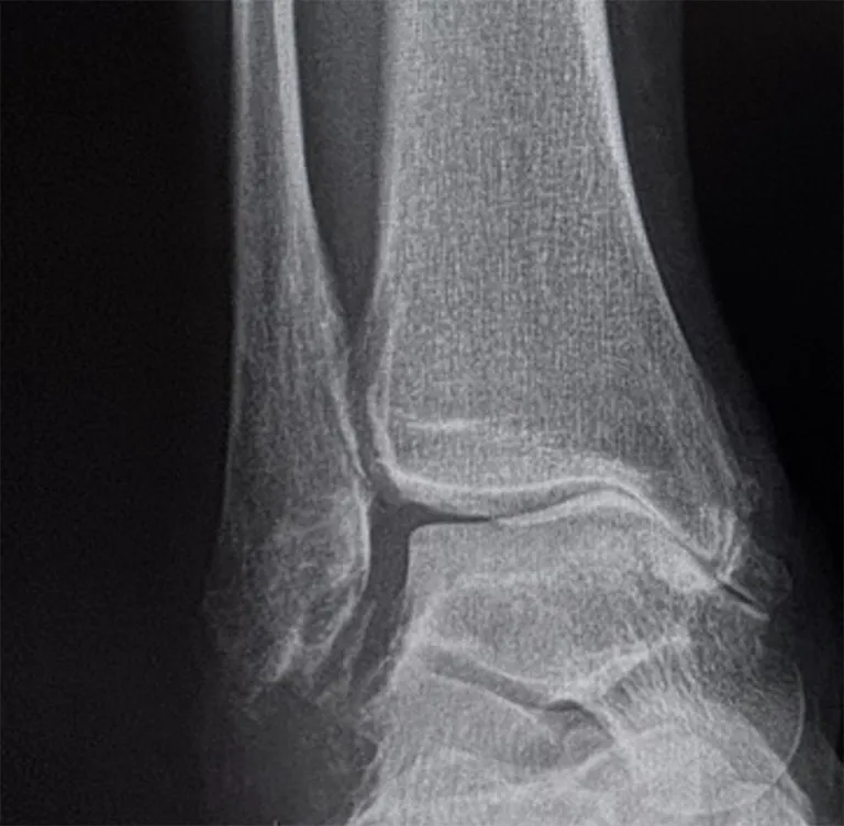 Distal Tibial Realignment Osteotomy Xray