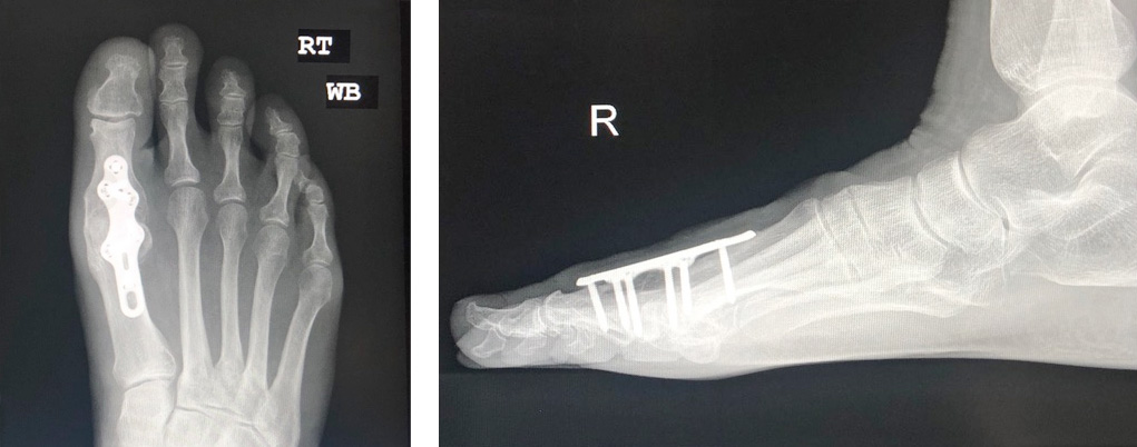 1st Metatarsophalangeal Fusion xrays