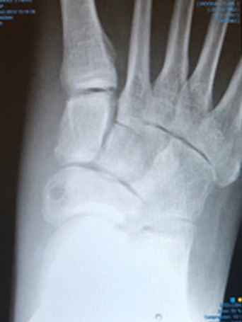 Flat Foot Correction Xray FDL Tendon