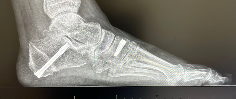 Flat Foot Correction Xray Calcaneal Screw