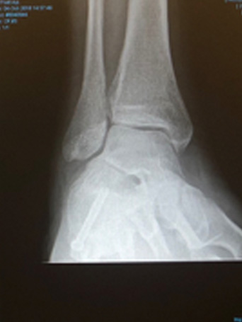 Flat Foot Correction Xray Calcaneal Osteotomy