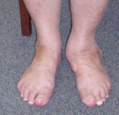 Flat Foot Correction Posterior Tibial Tendon Dysfunction Peter Rosenfeld Frcs London