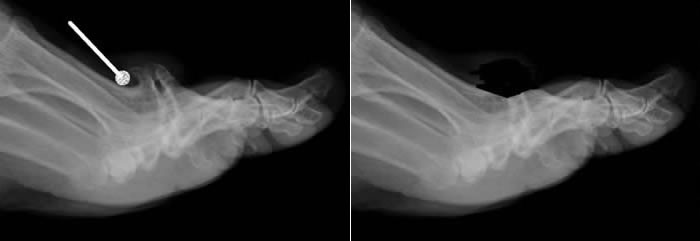 Hallux Rigidus Xrays