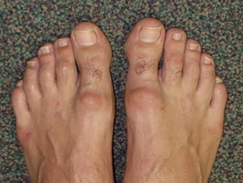 Hallux Rigidus