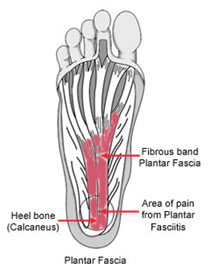 Heel pain diagram