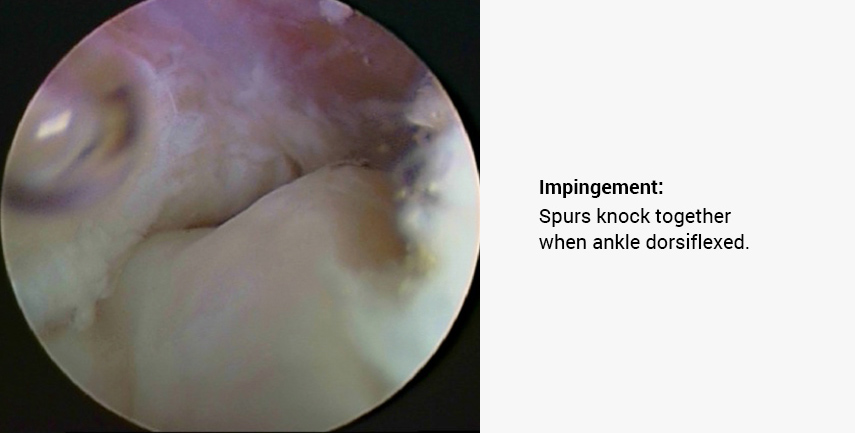 Impingement