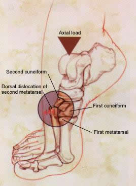 Lisfranc Axial Load