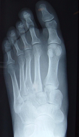 lisfranc injury with slip at base of 2nd Metatarsal