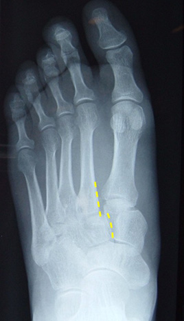 lisfranc injury with slip at base of 2nd Metatarsal lines