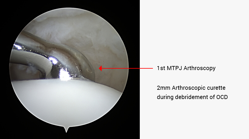 Metatarsophalangeal Joint Arthroscopy
