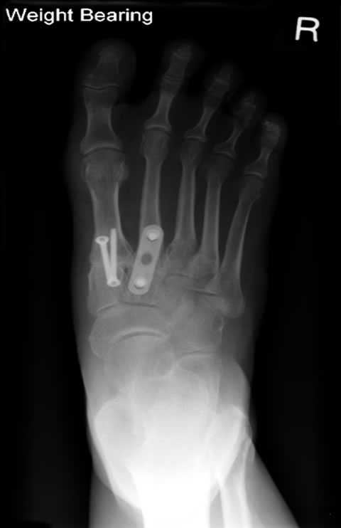 Mid Fusion Xray weight bearing