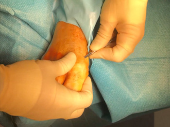 Minimally Invasive Cheilectomy