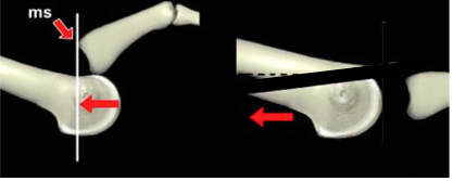 Minimally Invasive Metatarsal Osteotomy