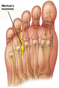 Morton's Neuroma diagram